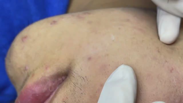 065 • Acne Collection • АСМР • Relax Spa