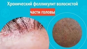 😯 Хронический фолликулит волосистой части головы. Клинический случай № 1767