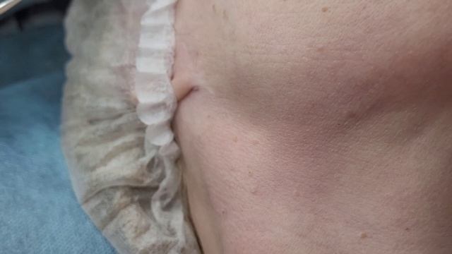 Электрокоагуляция мелких папиллом на коже шеи