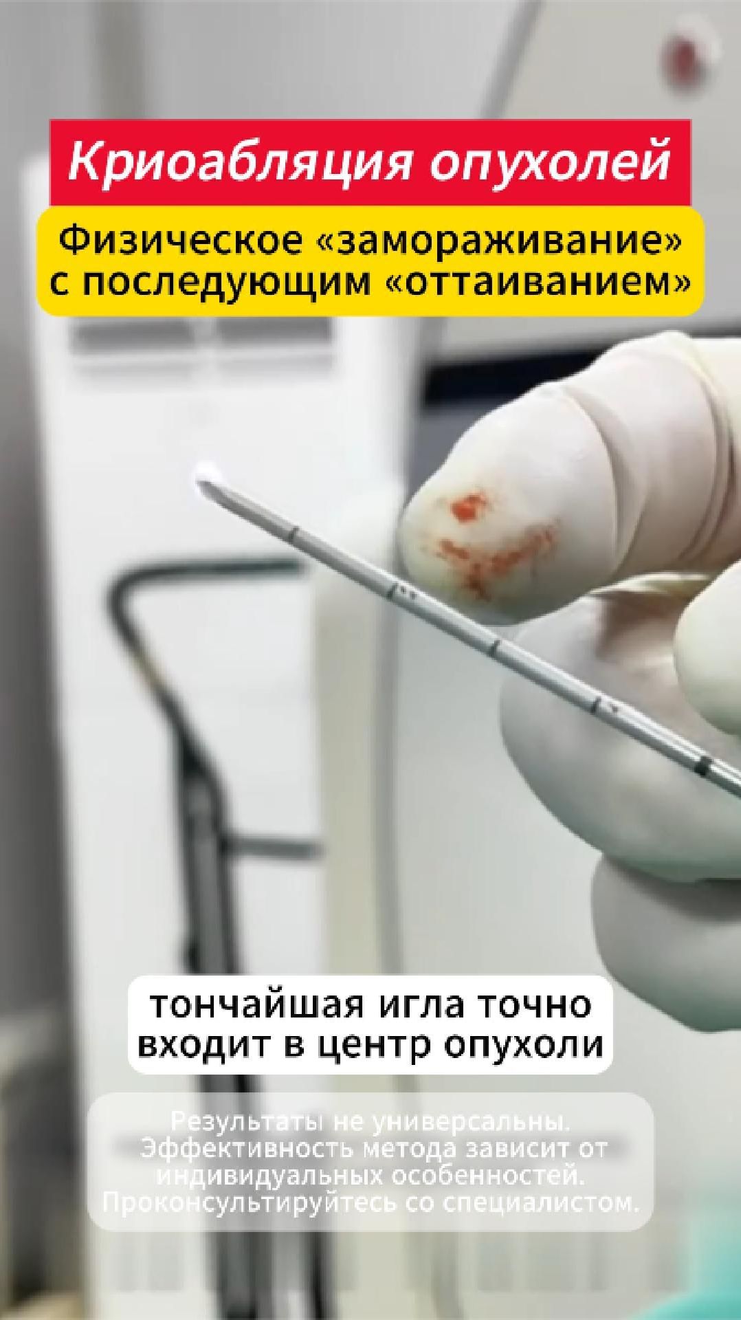Криоабляция опухоли (лечение опухоли холодом)