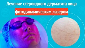 ✅ Лечение стероидного дерматита лица фотодинамическим лазером. Клинический случай № 1768