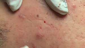 Удаление смешанных типов комедонов и акне