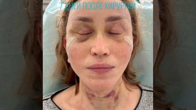 7 дней после комбинированной операции подтяжки лица