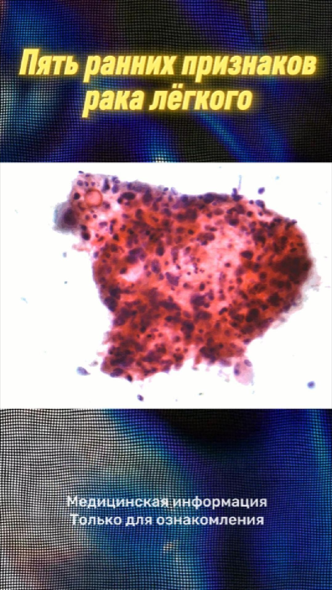 5 ранних признаков рака лекого