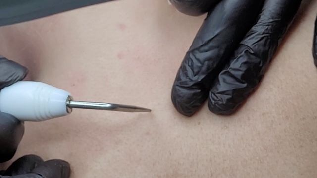 Чистая кожа - удаления мелких новообразований на задней поверхности шеи и плеч