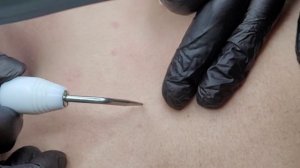 Чистая кожа - удаления мелких новообразований на задней поверхности шеи и плеч