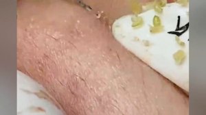 Выдавливание прыщей, угрей, черных точек и камедонов #349