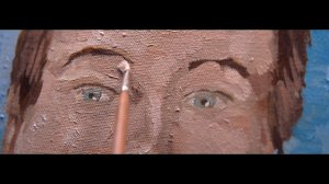 Блефаропластика. История пациента