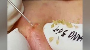 Выдавливание прыщей, угрей, черных точек и камедонов #348