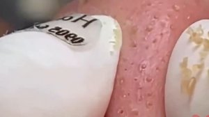 #251 Чистка лица от угрей и акне. Выдавливание прыщей. Удаление черных точек и комедонов