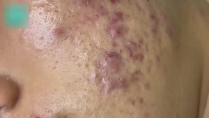 Механическая экстракция прыщей