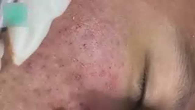 Профессиональная чистка лица с удалением акне