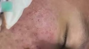 Профессиональная чистка лица с удалением акне