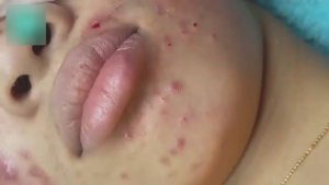 Полное очищение пор и удаление акне