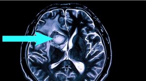 Цена на стентирование сердца и мозга. Как сделать бесплатно всем.