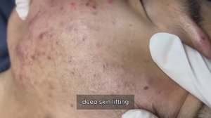 Удаление черных точек и акне: путь к гладкости