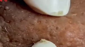 #250 Чистка лица от угрей и акне. Выдавливание прыщей. Удаление черных точек и комедонов