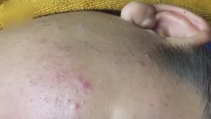 Расслабляющее удаление черных точек и акне