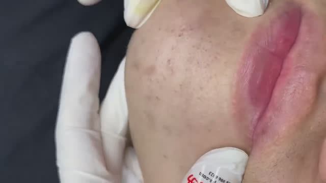 070 • Acne Collection • АСМР • Relax Spa