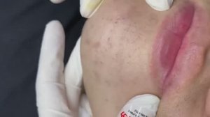 070 • Acne collection • АСМР • Relax Spa