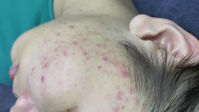 071 • Acne Collection • АСМР • Relax Spa