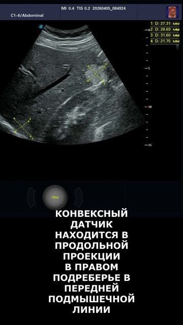 Гемангиомы печени на УЗИ
