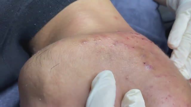 069 • Acne collection • АСМР • Relax Spa