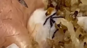 #252 Чистка лица от угрей и акне. Выдавливание прыщей. Удаление черных точек и комедонов