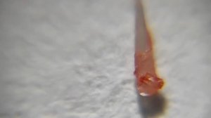 Удаление занозы под увеличением