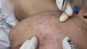 Экстракция элементов акне и черных точек