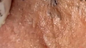 #254 Чистка лица от угрей и акне. Выдавливание прыщей. Удаление черных точек и комедонов