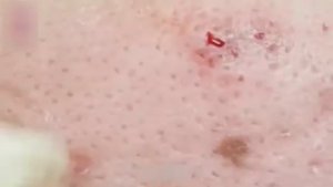 Удаление черных точек с любовью и заботой