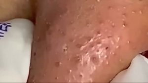 #253 Чистка лица от угрей и акне. Выдавливание прыщей. Удаление черных точек и комедонов