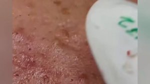 Выдавливание прыщей, угрей, черных точек и камедонов #352