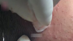 Аккуратное удаление черных точек на лбу и подбородке