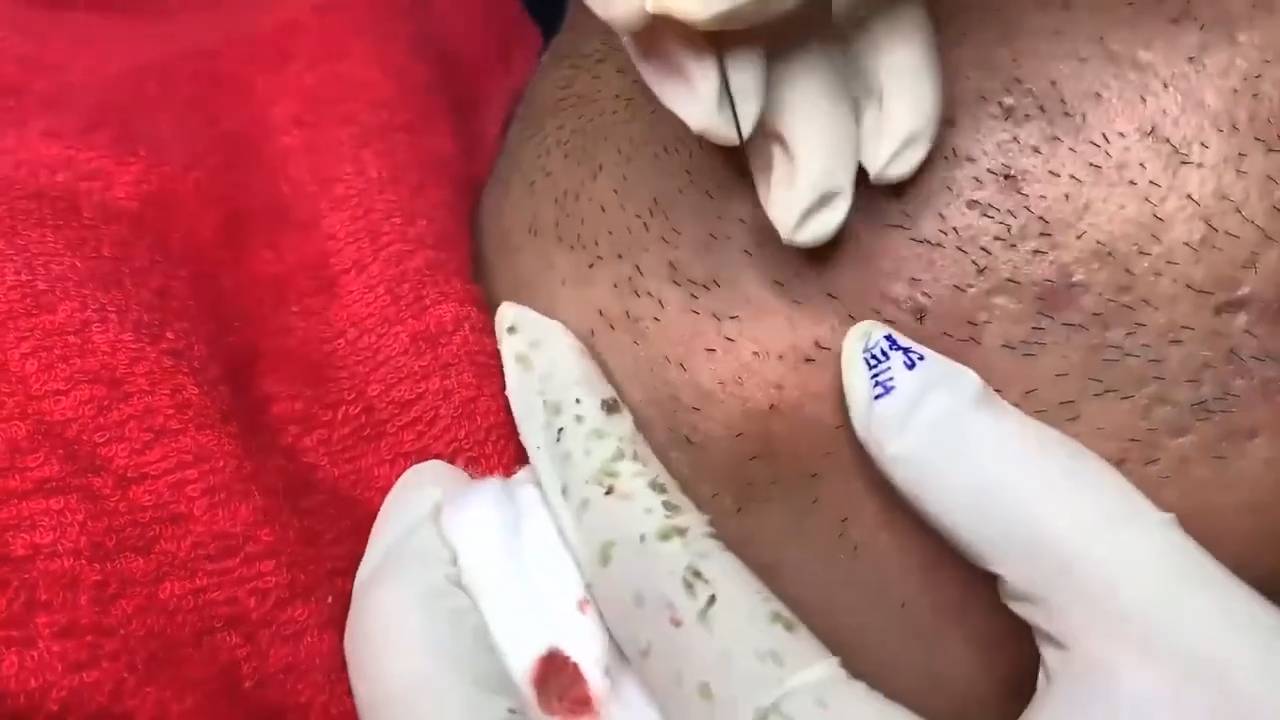 черные точки, акне. прыщи давить прыщи залипательное развлекательное видео