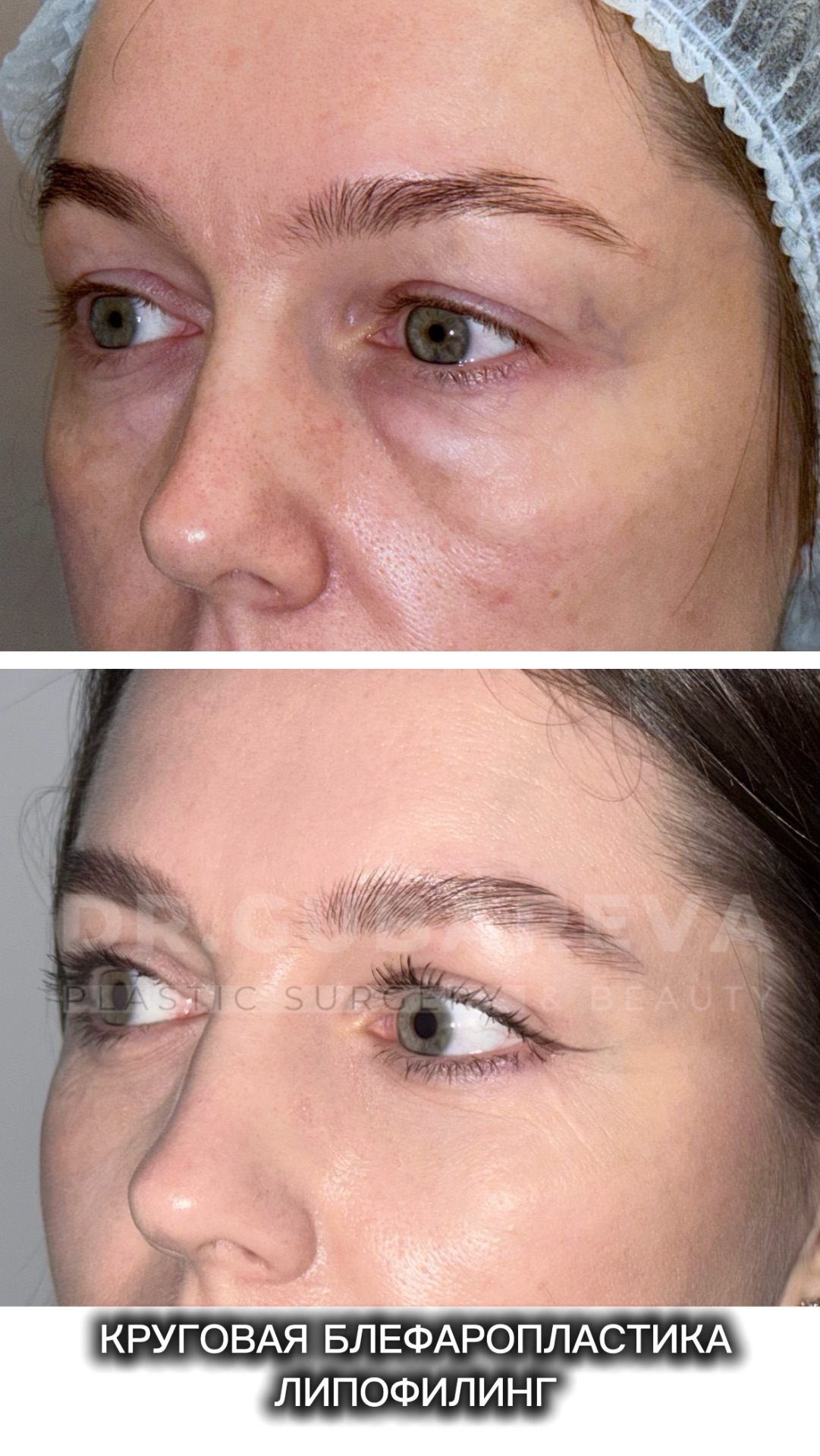 Результат круговой блефаропластики и липофилинга спустя 3 месяца 🔥