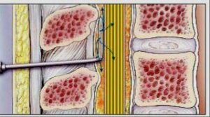 Нестандартный способ верификации эпидурального пространства