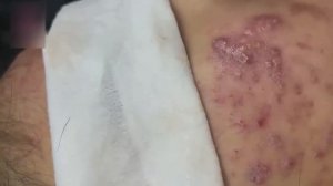 Удаление комедонов: самые залипательные моменты