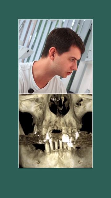 Планирование ALL ON 6