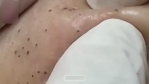 Экстракция акне и черных точек