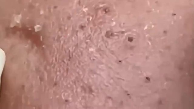 #255 Чистка лица от угрей и акне. Выдавливание прыщей. Удаление черных точек и комедонов