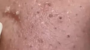 #255 Чистка лица от угрей и акне. Выдавливание прыщей. Удаление черных точек и комедонов