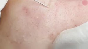 Генеральная уборка лица: как мы выметаем все акне