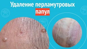 ✅ Удаление перламутровых папул. Клинический случай №1386