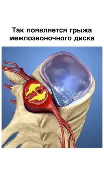 ЧТО ТАКОЕ ПРОТРУЗИЯ И ГРЫЖА В ПОЗВОНОЧНИКЕ / МЕДИЦИНА И ЗДОРОВЬЕ