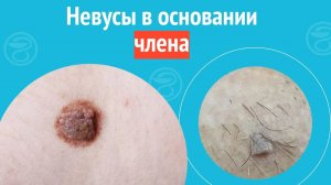 🥺 Шелушащиеся пятна на члене. Клинический случай №1387