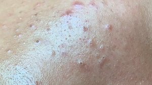 Лечение застарелого акне