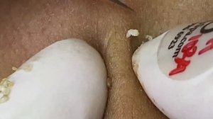 Выдавливание прыщей, угрей, черных точек и камедонов #355