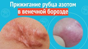 ♨️ Прижигание рубца азотом в венечной борозде. Клинический случай №1384